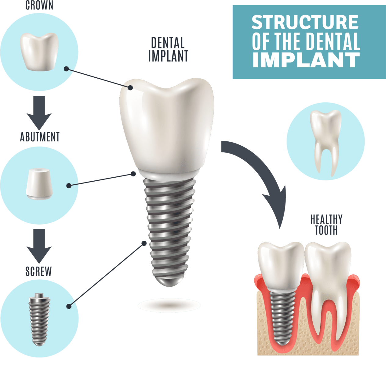 Dental implants how they work what are made of tooth wisdom cost clipart picture