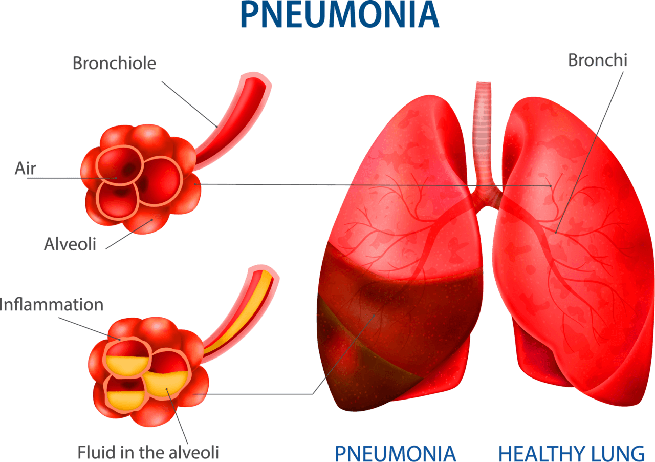 Lungs pneumonia human lung fographic diagram clipart vector