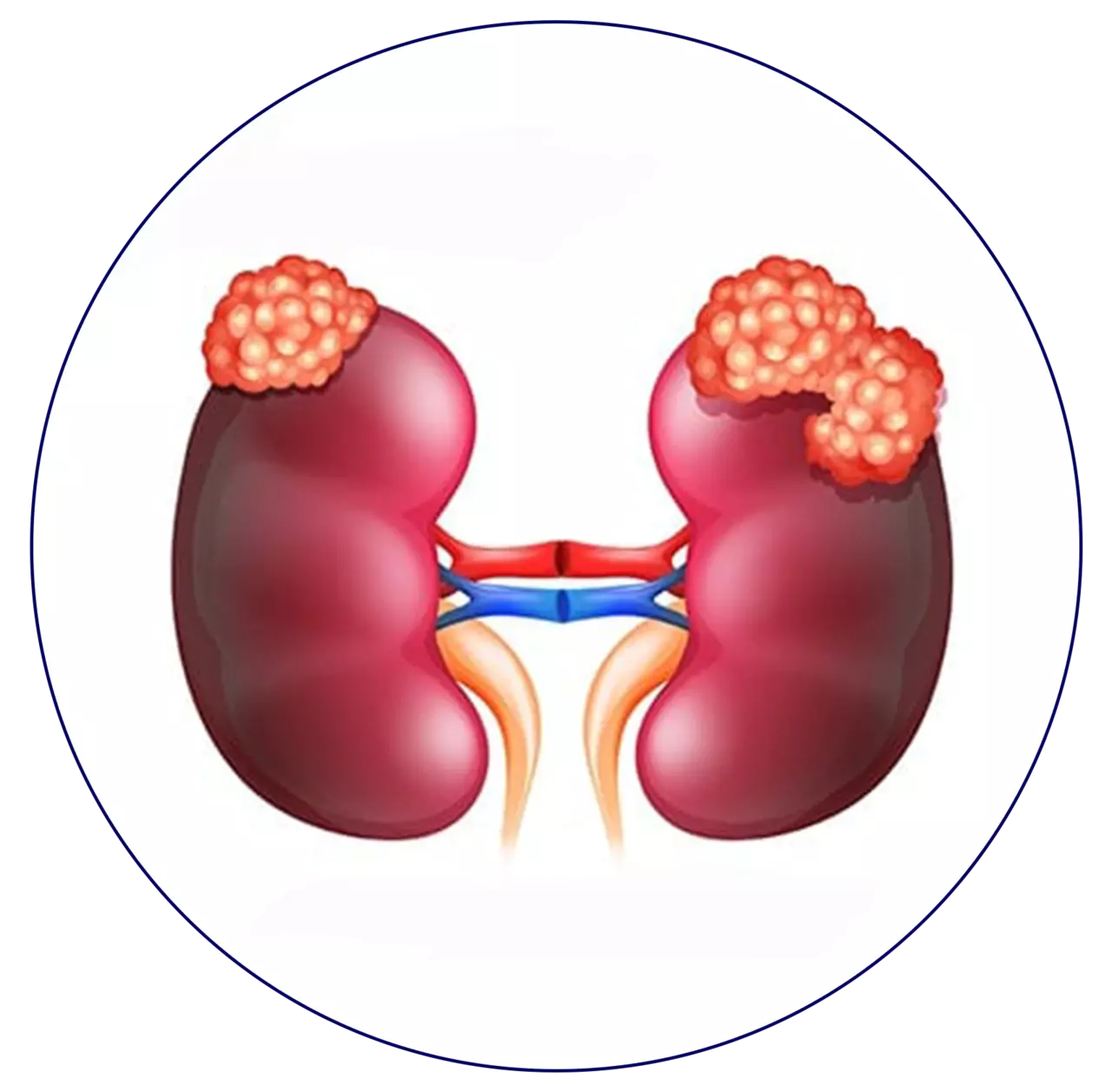 Kidney cancer draditya mantri clipart photo